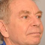 Brow Lift Delaware | Premier Cosmetic Surgery DE