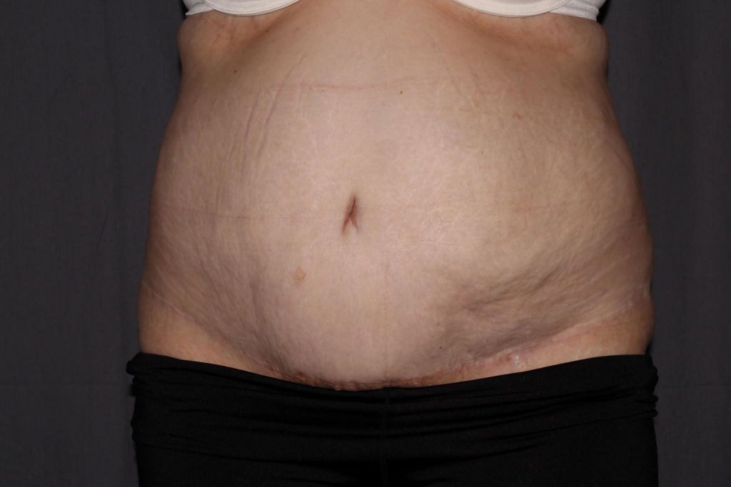 Abdominoplasty Delaware | Premier Cosmetic Surgery DE