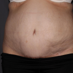 Abdominoplasty Delaware | Premier Cosmetic Surgery DE