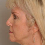 Brow Lift Delaware | Premier Cosmetic Surgery DE