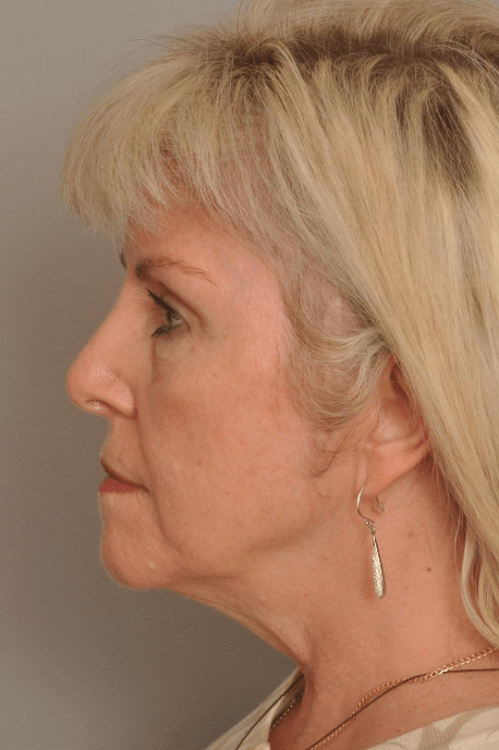 Brow Lift Delaware | Premier Cosmetic Surgery DE