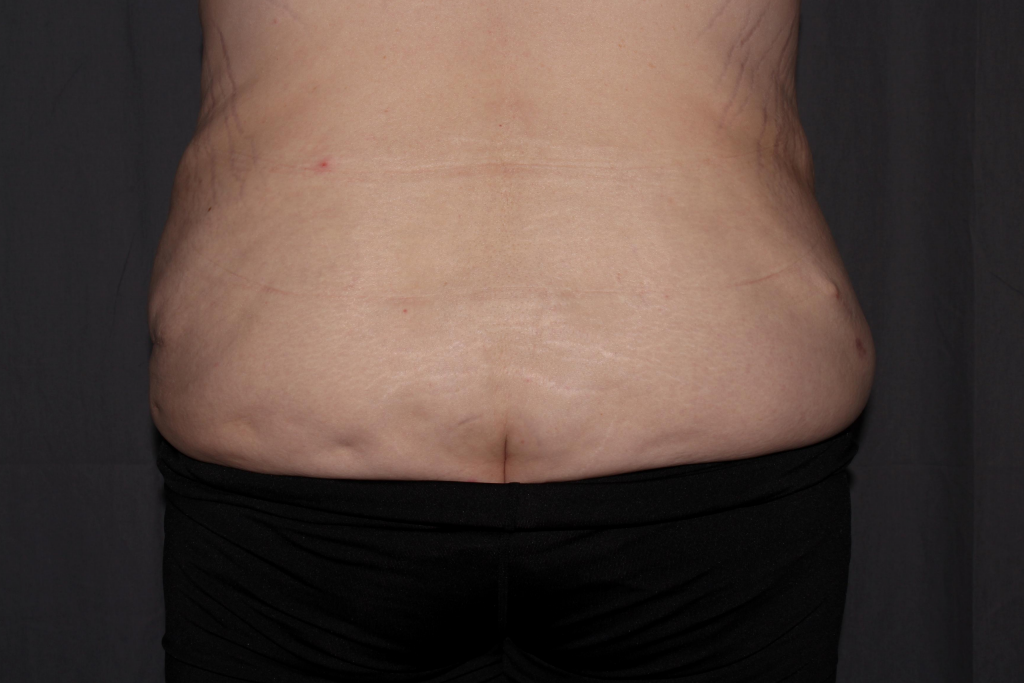 Abdominoplasty Delaware | Premier Cosmetic Surgery DE