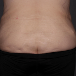 Abdominoplasty Delaware | Premier Cosmetic Surgery DE