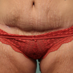 Abdominoplasty Delaware | Premier Cosmetic Surgery DE