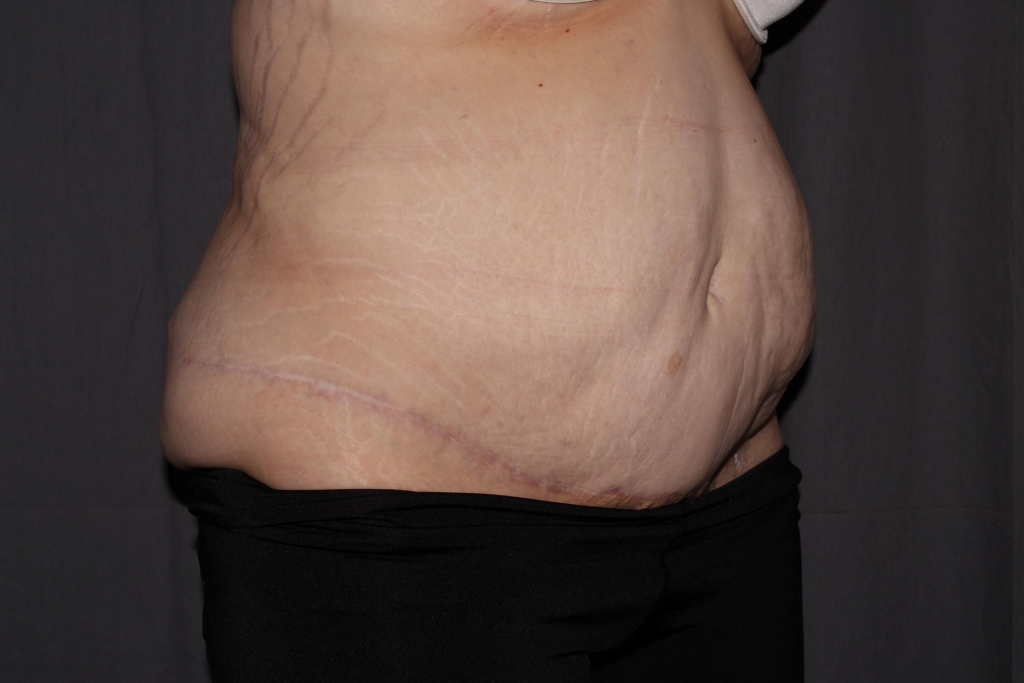 Abdominoplasty Delaware | Premier Cosmetic Surgery DE