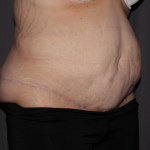 Abdominoplasty Delaware | Premier Cosmetic Surgery DE