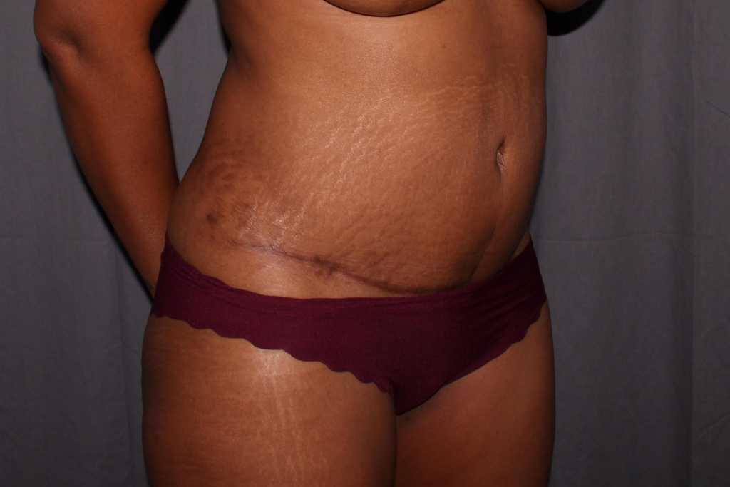 Abdominoplasty Delaware | Premier Cosmetic Surgery DE