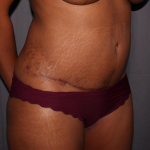 Abdominoplasty Delaware | Premier Cosmetic Surgery DE