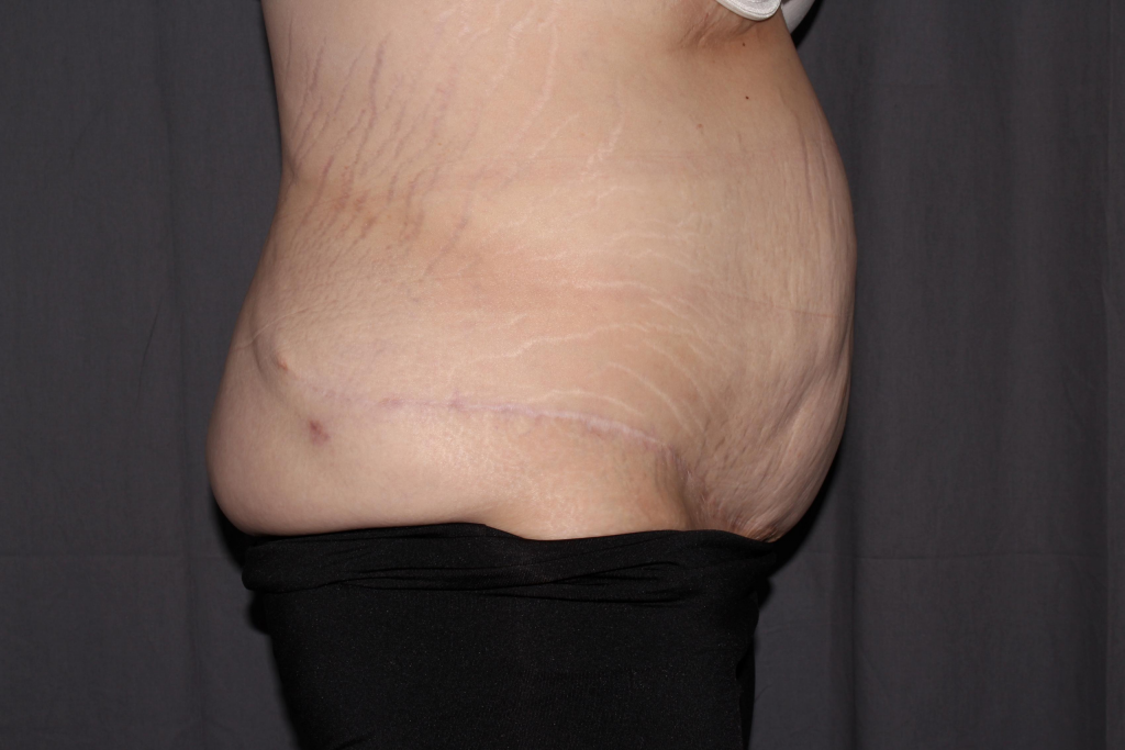 Abdominoplasty Delaware | Premier Cosmetic Surgery DE