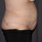 Abdominoplasty Delaware | Premier Cosmetic Surgery DE