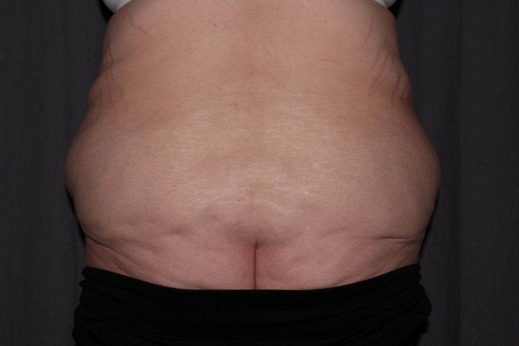 Abdominoplasty Delaware | Premier Cosmetic Surgery DE