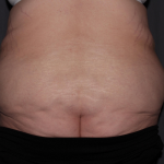 Abdominoplasty Delaware | Premier Cosmetic Surgery DE