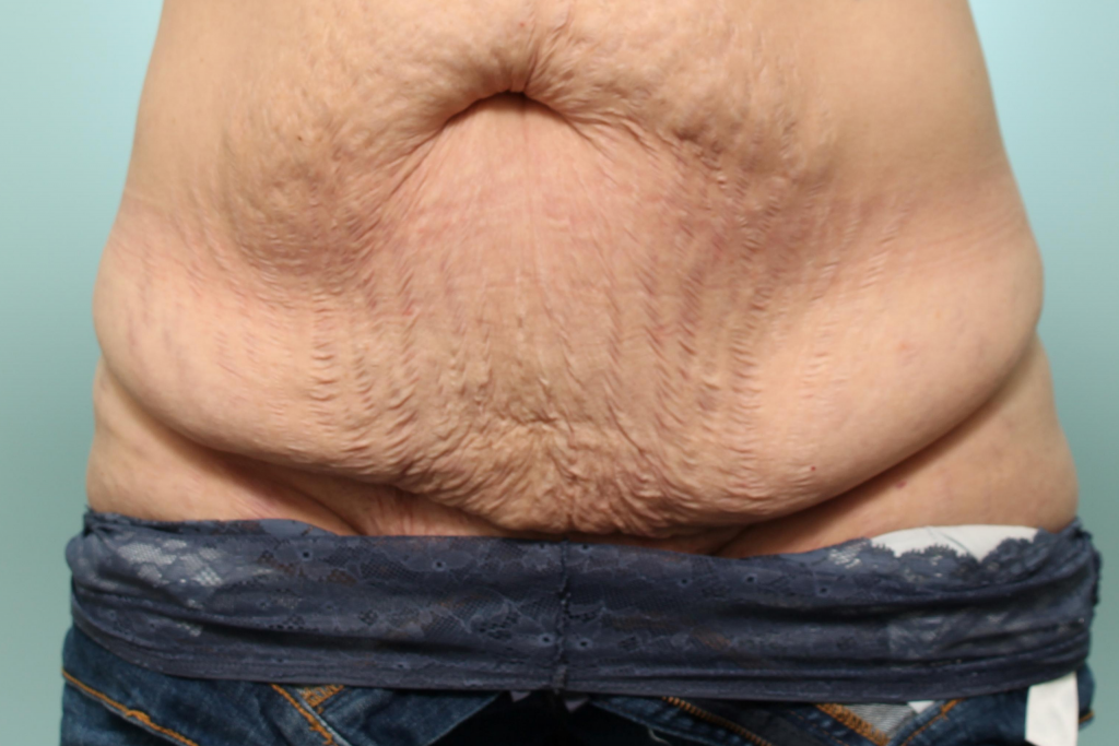 Abdominoplasty Delaware | Premier Cosmetic Surgery DE