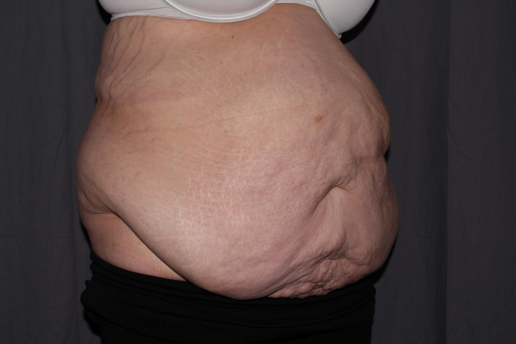 Abdominoplasty Delaware | Premier Cosmetic Surgery DE