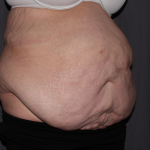 Abdominoplasty Delaware | Premier Cosmetic Surgery DE