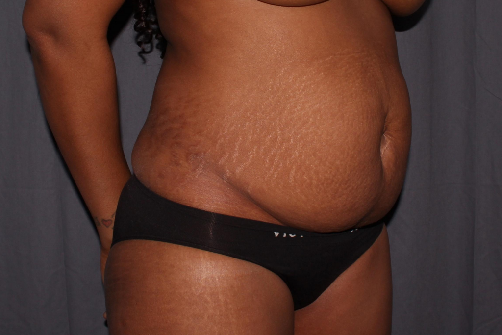 Abdominoplasty Delaware | Premier Cosmetic Surgery DE