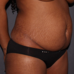 Abdominoplasty Delaware | Premier Cosmetic Surgery DE