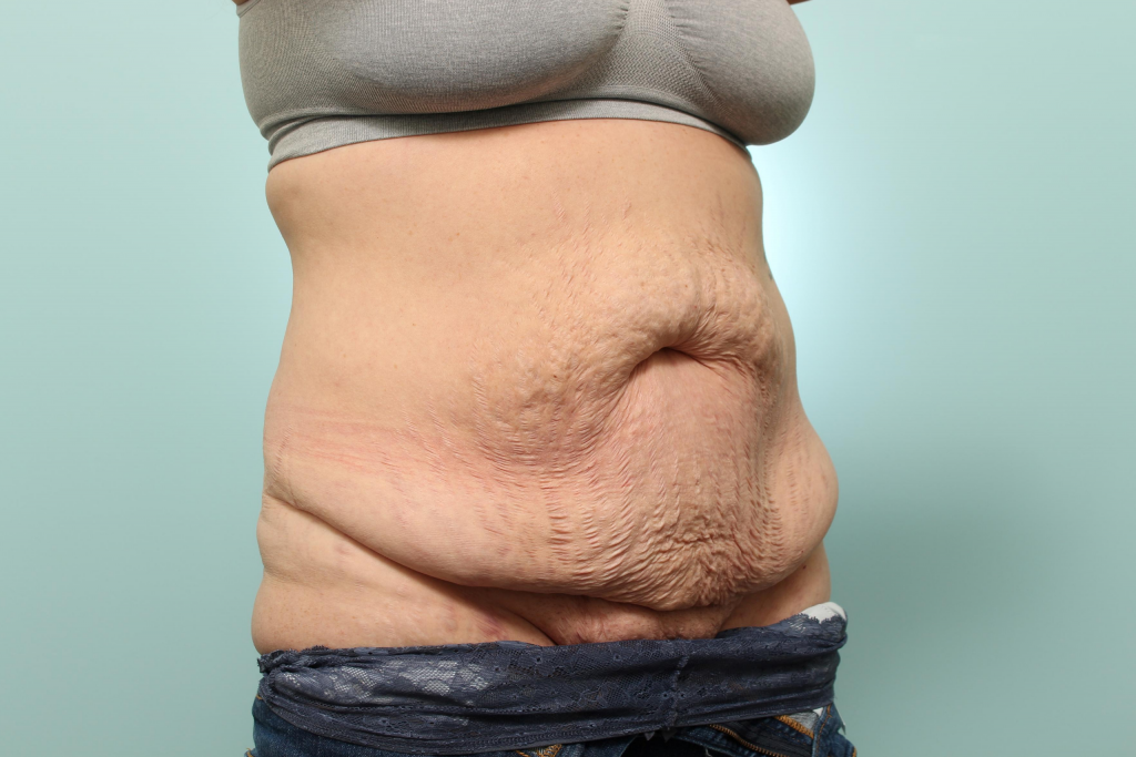 Abdominoplasty Delaware | Premier Cosmetic Surgery DE