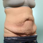 Abdominoplasty Delaware | Premier Cosmetic Surgery DE