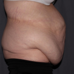 Abdominoplasty Delaware | Premier Cosmetic Surgery DE