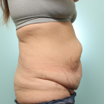 Abdominoplasty Delaware | Premier Cosmetic Surgery DE