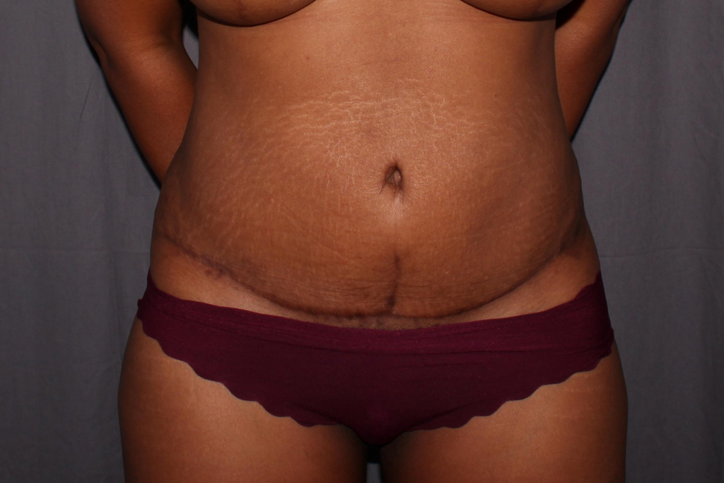 Abdominoplasty Delaware | Premier Cosmetic Surgery DE