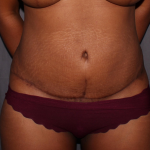 Abdominoplasty Delaware | Premier Cosmetic Surgery DE