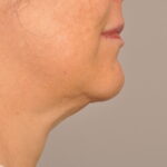 Ultherapy Delaware | Premier Cosmetic Surgery DE