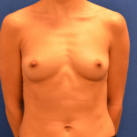 Breast Augmentation Delaware | Premier Cosmetic Surgery DE