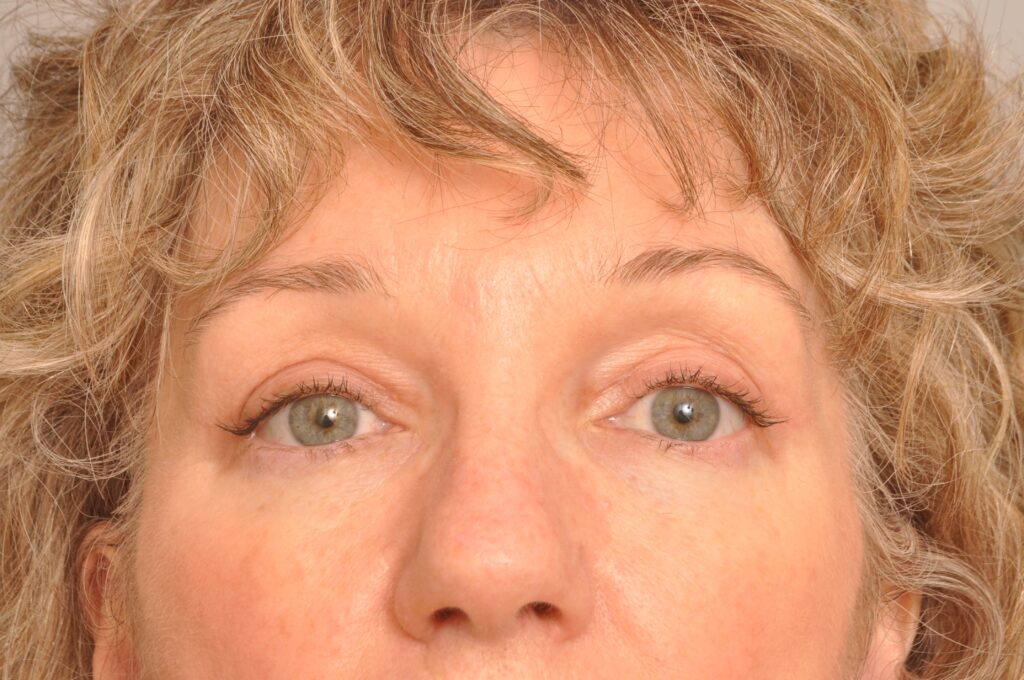 Blepharoplasty Eyelid Surgery Delaware | Premier Cosmetic Surgery DE