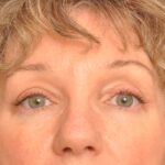 Blepharoplasty Eyelid Surgery Delaware | Premier Cosmetic Surgery DE