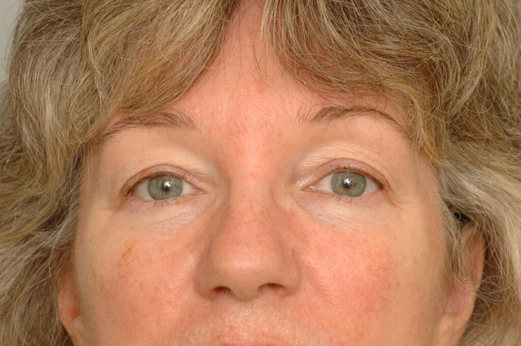 Blepharoplasty Eyelid Surgery Delaware | Premier Cosmetic Surgery DE