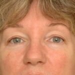 Blepharoplasty Eyelid Surgery Delaware | Premier Cosmetic Surgery DE