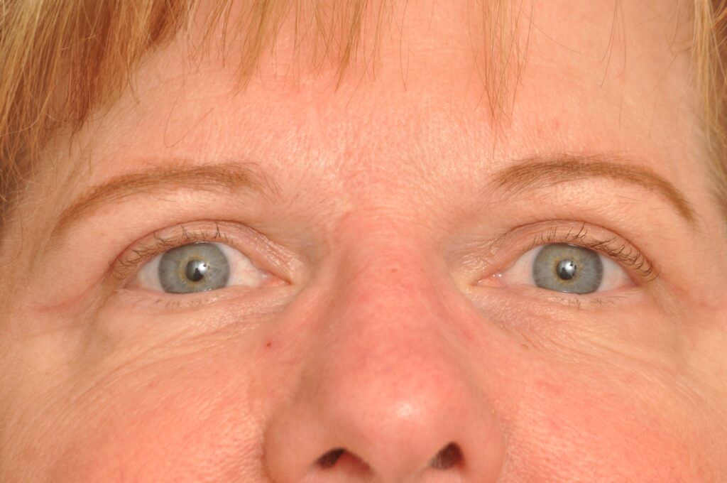 Blepharoplasty Eyelid Surgery Delaware | Premier Cosmetic Surgery DE