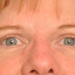 Blepharoplasty Eyelid Surgery Delaware | Premier Cosmetic Surgery DE