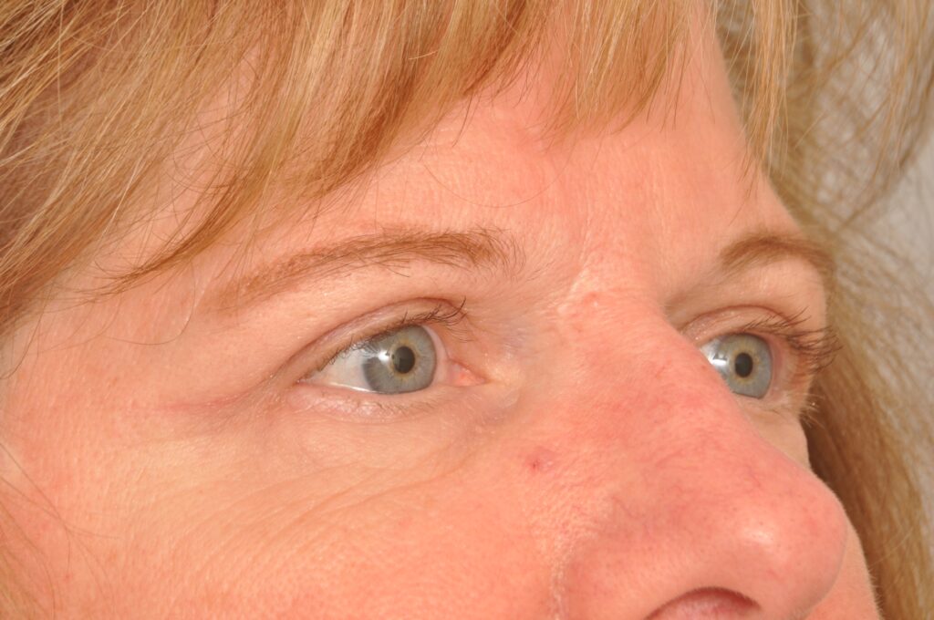 Blepharoplasty Eyelid Surgery Delaware | Premier Cosmetic Surgery DE