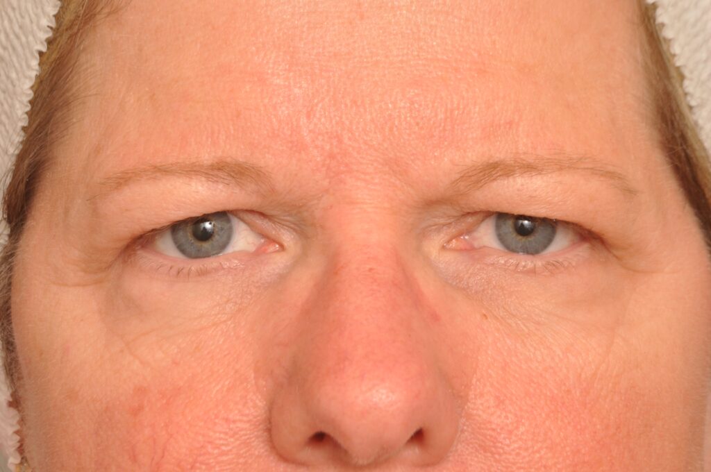 Blepharoplasty Eyelid Surgery Delaware | Premier Cosmetic Surgery DE