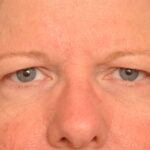 Blepharoplasty Eyelid Surgery Delaware | Premier Cosmetic Surgery DE