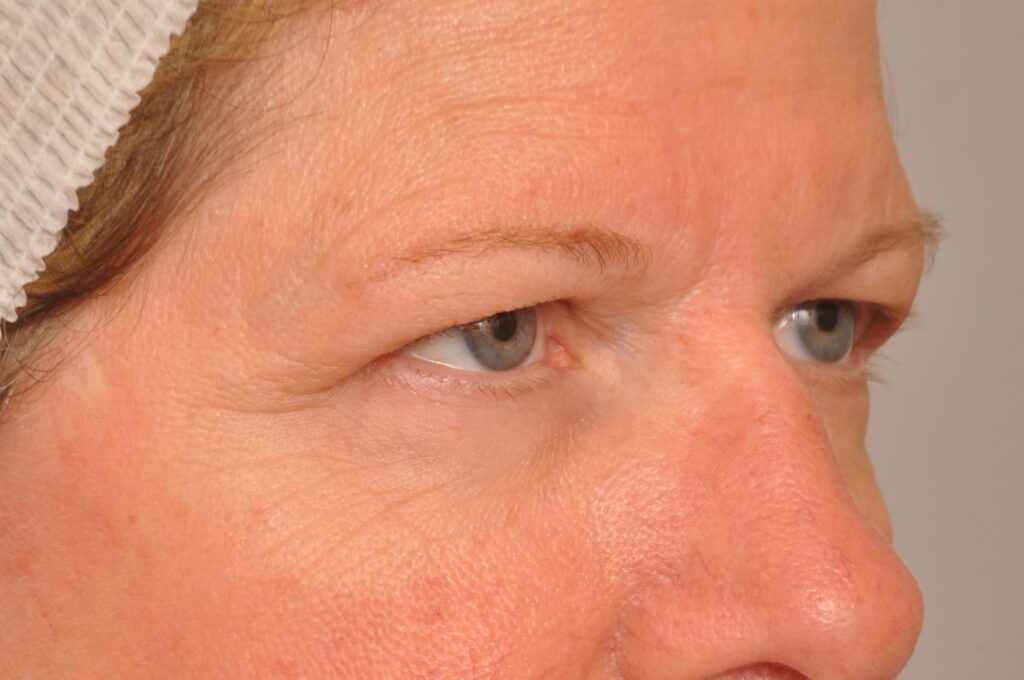 Blepharoplasty Eyelid Surgery Delaware | Premier Cosmetic Surgery DE