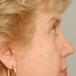 Blepharoplasty Eyelid Surgery Delaware | Premier Cosmetic Surgery DE