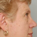 Blepharoplasty Eyelid Surgery Delaware | Premier Cosmetic Surgery DE