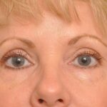 Botox Delaware | Premier Cosmetic Surgery DE
