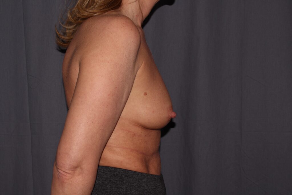 Breast Augmentation Delaware | Premier Cosmetic Surgery DE