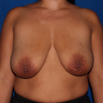 Breast Reduction Delaware | Premier Cosmetic Surgery DE