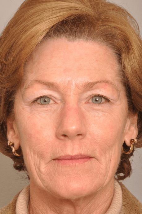 Brow Lift Delaware | Premier Cosmetic Surgery DE