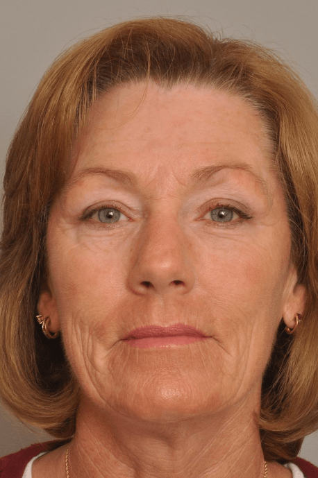 Brow Lift Delaware | Premier Cosmetic Surgery DE