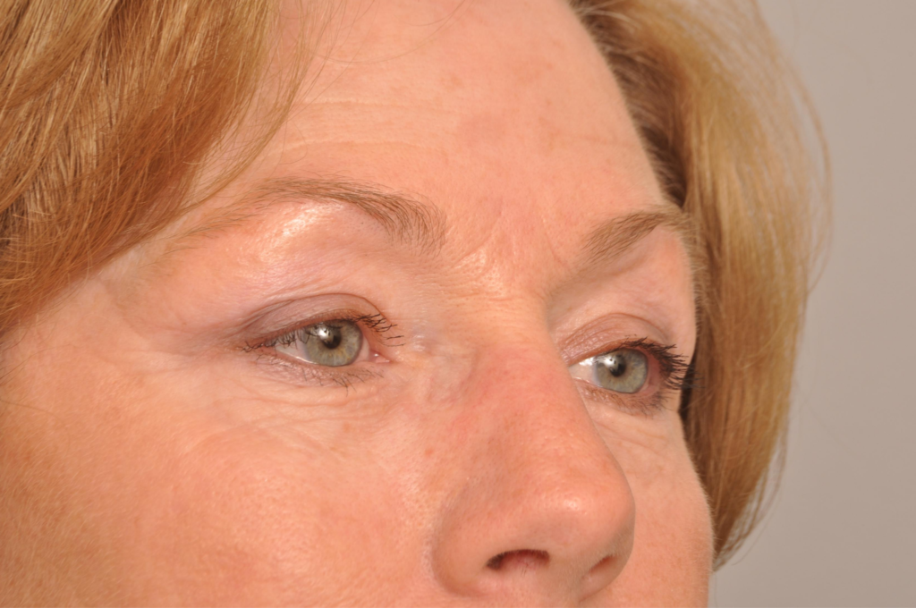 Brow Lift Delaware | Premier Cosmetic Surgery DE