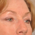 Brow Lift Delaware | Premier Cosmetic Surgery DE