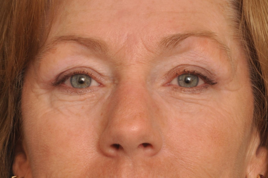 Brow Lift Delaware | Premier Cosmetic Surgery DE