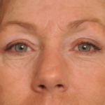 Brow Lift Delaware | Premier Cosmetic Surgery DE